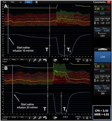 Microvascular Dysfunction in Patients With Type II Diabetes Mellitus: Invasive Assessment of Absolute Coronary Blood Flow and Microvascular Resistance Reserve
